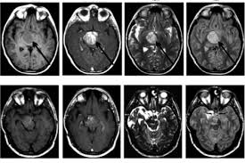 After leukemia, brain and other cns tumors are the second most common childhood cancers, accounting for about 27% of cancer in children younger than 15. New Immunotherapy For Deadly Childhood Brain Cancer Targets Novel Neoantigen Uc San Francisco