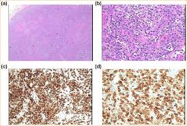 Blood diseases, cancer diseases, immune diseases, rare diseases. Sequential Complications Of Hypercalcemia Necrotizing Granulomatous Vasculitis And Aplastic Anemia Occurring In One Patient With Angioimmunoblastic T Cell Lymphoma The American Journal Of The Medical Sciences