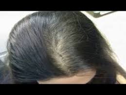 Hair Back For Hair Loss Review االعلاج الجذري لتساقط الشعر و الصلع Youtube