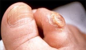 We did not find results for: Corns And Calluses Achilles Podiatry