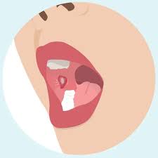 Image result for mouth ulcer on tongue)