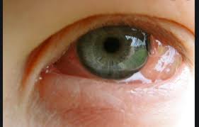 Det hårt pressade flygbolaget skriver i ett pressmeddelande att bokningarna ökar inför sommaren och hösten. Det Roda Ogat Konjunktiva Och Sclera Flashcards Quizlet