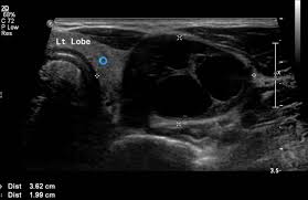 Cureus Unusual Thyroid Nodule A Case Of Symptomatic Thyroid Schwannoma