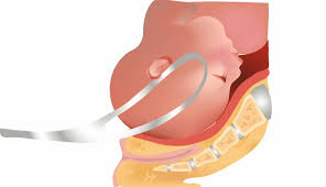 Image result for Forceps Assisted Delivery
