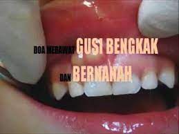 Radang gusi atau dalam medis disebut gingivitis merupakan peradangan pada bagian gusi. Doa Merawat Gusi Bengkak Dan Bernanah Dua To Treat Swollen Gum And Pocket Of Pus Abscess Youtube