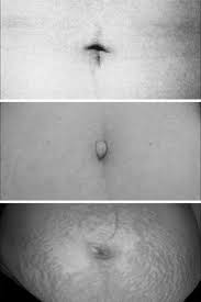 Image result for Umbilicus