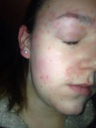 Student claims she's found a bizarre 'cure' for the agonising psoriasis  left her a recluse