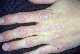 Dermatomyositis Myositis Support And Understanding The symptoms of dermatomyositis are similar to those of polymyositis, but there's also a distinctive rash.