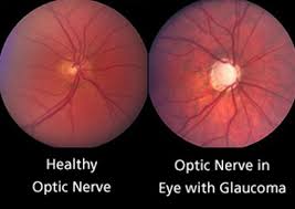 Image result for Glaucoma