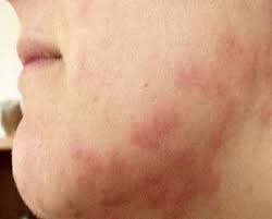 Image result for mite bites on humans