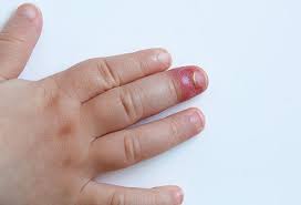 Sepsis sepsis is an infection of the bloodstream that leads to a widespread inflammatory response. Finger Infection Treatment Types Causes Pictures Home Remedies