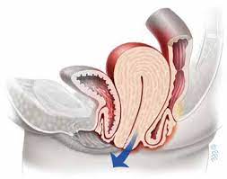 Menometrorrhagia Pelvic Organ Prolapse-Menometrorrhagia-Causes-Symptoms-Diagnosis | Homeopathic | Best Homeopathic Doctor in Pakistan | Dr Qaisar Ahmed MD, DHMS