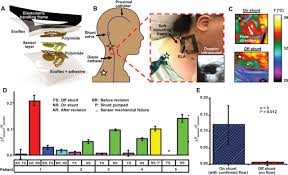 Epidermal Electronics For Noninvasive Wireless Quantitative Assessment Of Ventricular Shunt Function In Patients With Hydrocephalus Science Translational Medicine