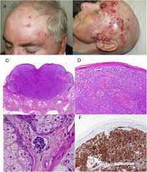 Image result for Merkel Cell Carcinoma