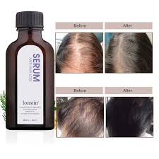 Bobby mansouri discusses hair loss treatment for women.schedule an online appointment here. Buy Hair Growth Serum Lonstin Ginger Hair Loss Treatments Hair Growth Oil For Stronger Thicker Longer Fuller Healthy Hair Repairs Hair Follicles Prevent Hair Loss Thinning For Men And Women 50ml