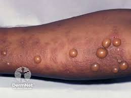 Image result for Pemphigoid