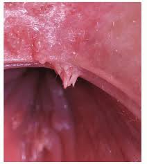 Pdf] Vestibular Papillomatosis: A Benign Condition Mimicking Genital Warts.  | Semantic Scholar