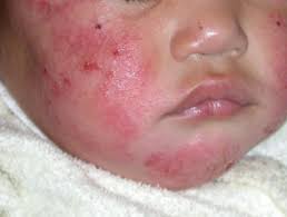 But the problem is all the eczema on my checks and forehead. Causes Of Atopic Dermatitis Dermnet Nz