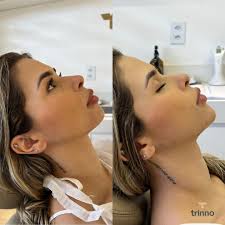 Olha só como era o sorriso do Raul e como está agora! ✨😊✨ O Raul juntou-se  ao Dr. Euriberto Santana, e após um minucioso trabalho de confecção e  planejamento, produziu esse resultado