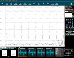 what to look for in electrophysiology ep reporting systems