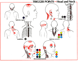 Trigger Point Referral Patterns Balance In Motion Bodywork