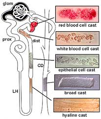 Image result for Urinary Cast