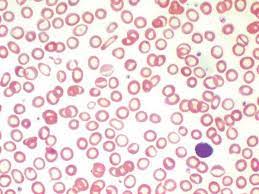 This is a trashy smear, but it does show an extremely advanced case of the microcytic/hypochromic anemia characteristic of iron deficiency. The Peripheral Blood Film In Severe Iron Deficiency Anaemia The Cells Download Scientific Diagram
