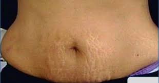 Celebrity Stretch Marks Beauty Health Beauty Hacks Homemade Beauty