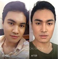 People Who Got Plastic Surgery In Their 20s