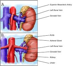 Nutcracker Syndrome Ncs Nyc Surgical Associates