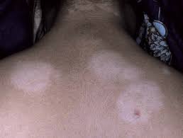 Image result for Postinflammatory Hypopigmentation