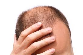 Image result for unusual hair loss public domain