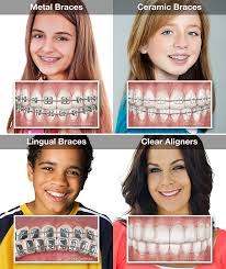 Maybe you would like to learn more about one of these? How Much Do Braces Cost Lakemoor Dental Orthodontics Arlington Heights Lakemoor Hainesville Elk Grove Village