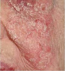 Image result for Pemphigus