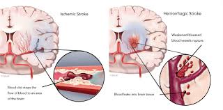 Symptoms are typically acute in onset and depend on the location of the stroke; Rodent Stroke Brain Ischemia Models Creative Biolabs