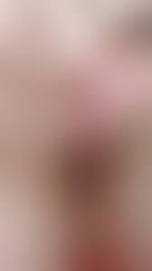 An updated video on how to drain your bartholin cyst at home. Nsfw Popping A Bartholin S Cyst Oc Popping