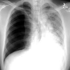 The air then fills the space outside of the lung, between the lung and chest wall. Pneumothorax X Ray Dr Buck Parker M D Facs