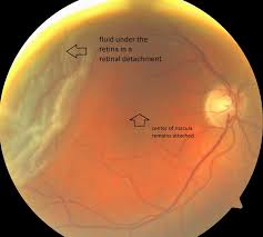 If untreated, perma­nent loss of vision may occur. Retinal Detachment In Sarasota Dr Stelton Md Retina Specialist