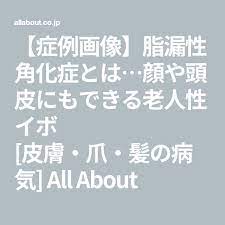症例画像 老人性イボ 脂漏性角化症 の治療 予防法 乾癬 治療 老人