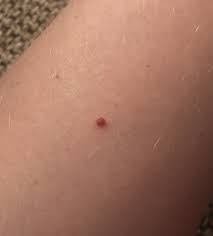 I had the exact ones that you're speaking of on top of my legs. Cherry Angioma Wikipedia