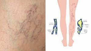 6 Causes Of Spider Veins And Tips To Prevent Them