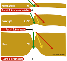 A gentle rotating action in a vertical direction was used to allow the bladeless tip to separate the tissues. Four Tips For Initial Laparoscopic Entry