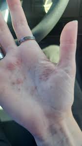 Image result for dyshidrosis