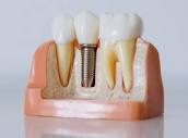 DENTAL IMPLANTS | Innova Dental Clinic