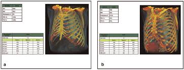 Rib cage pain can be associated with bruising, difficulty taking a deep breath, joint pain, and more. Rib Cage Morphometric Differences Between A Normal 58 Year Old Male Download Scientific Diagram