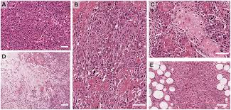 Breast cancer is one of the most common types of cancer in australia. An Update On The Molecular Pathology Of Metaplastic Breast Cancer Bctt