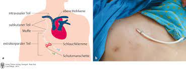 24 Gefasszugange Infusion Transfusion Pflegepadagogik Georg Thieme Verlag