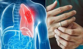 Often times, most of these symptoms related to lung cancer, including the listed syndromes, are the result of something other than lung cancer. Lung Cancer Symptoms Signs Of A Tumour Include A Cough And Fingertip Changes Express Co Uk