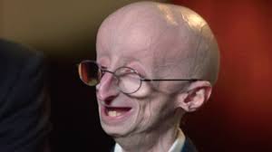 Sam the man burns with 'crossed the line' mix. The Triumphant Story Of Sam Berns Progeria And Math Video Abc News