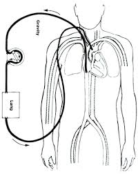 In the emergency room, a doctor, nurse, or technician will draw your blood to collect the sample. Extracorporeal Membrane Oxygenation Wikipedia